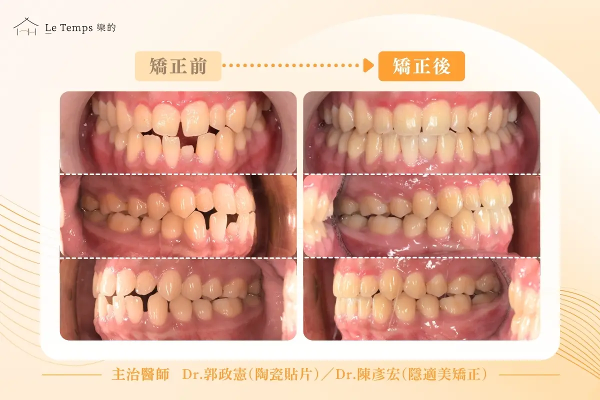 1215隱適美矯正陶瓷貼片案例分享2