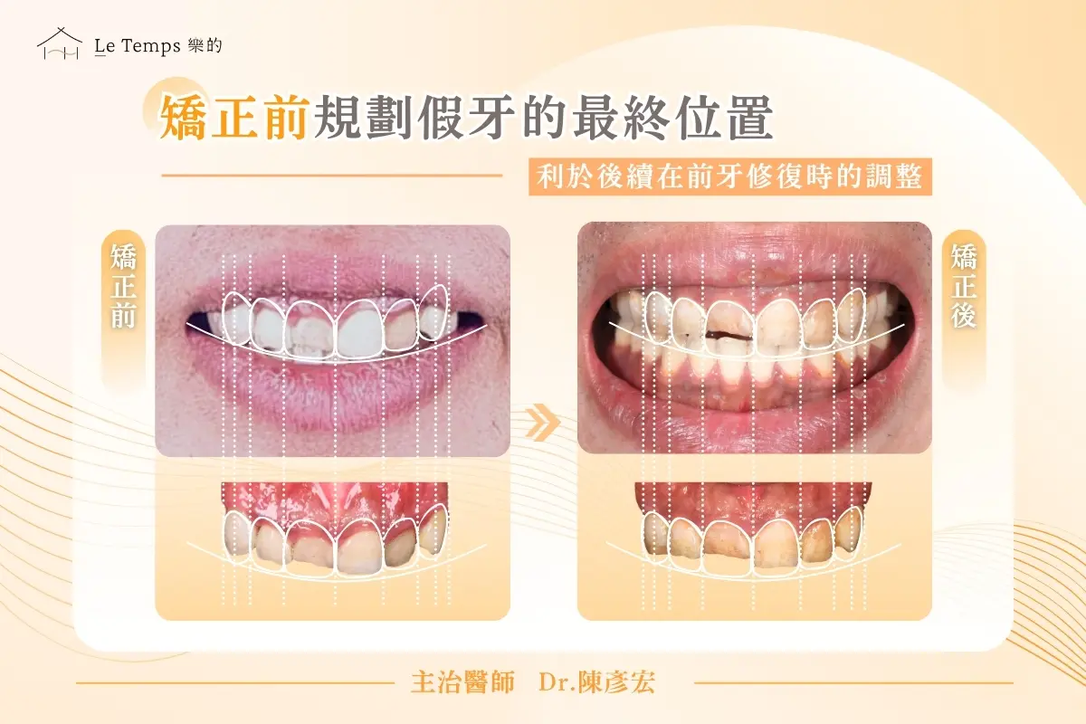 1208自鎖式矯正陶瓷貼片案例分享2