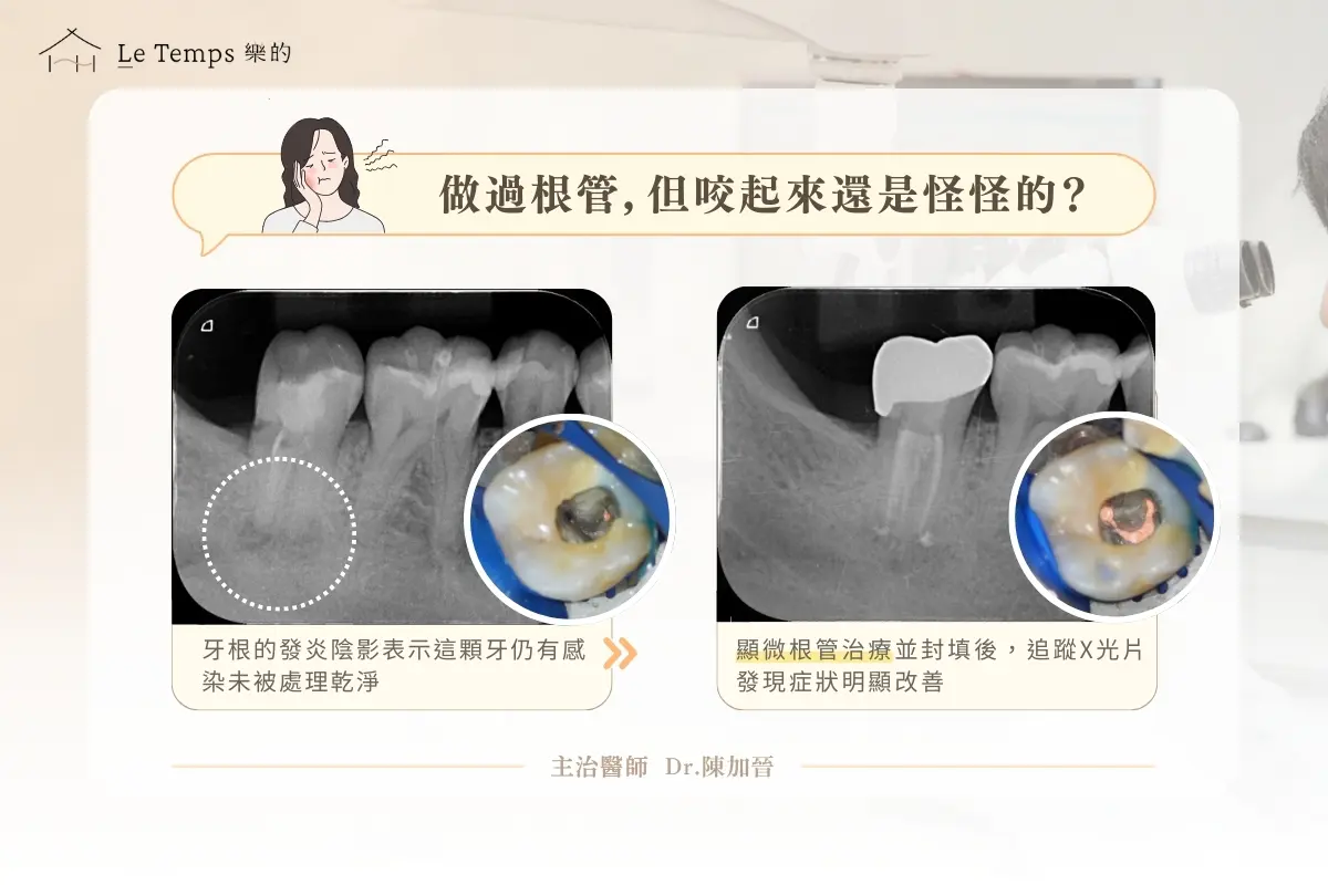 為什麼要選擇顯微根管?4