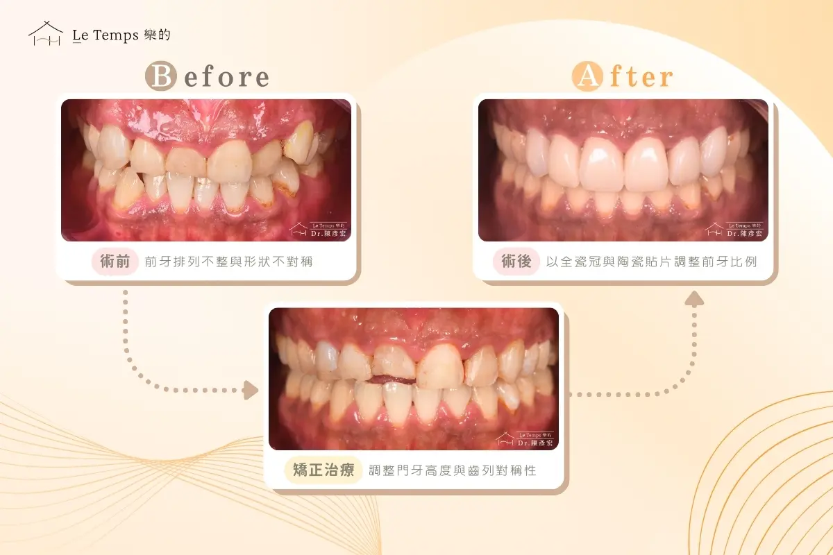 1208自鎖式矯正陶瓷貼片案例分享4