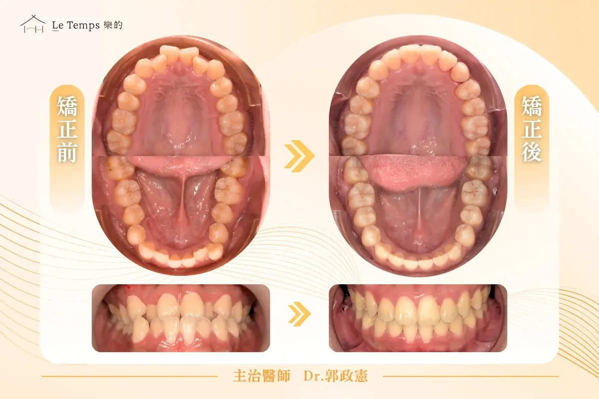 0126自鎖式矯正案例分享2