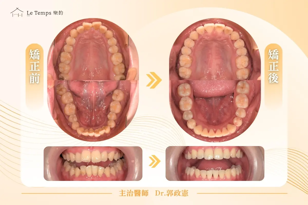 黃健翔 自鎖式矯正案例2