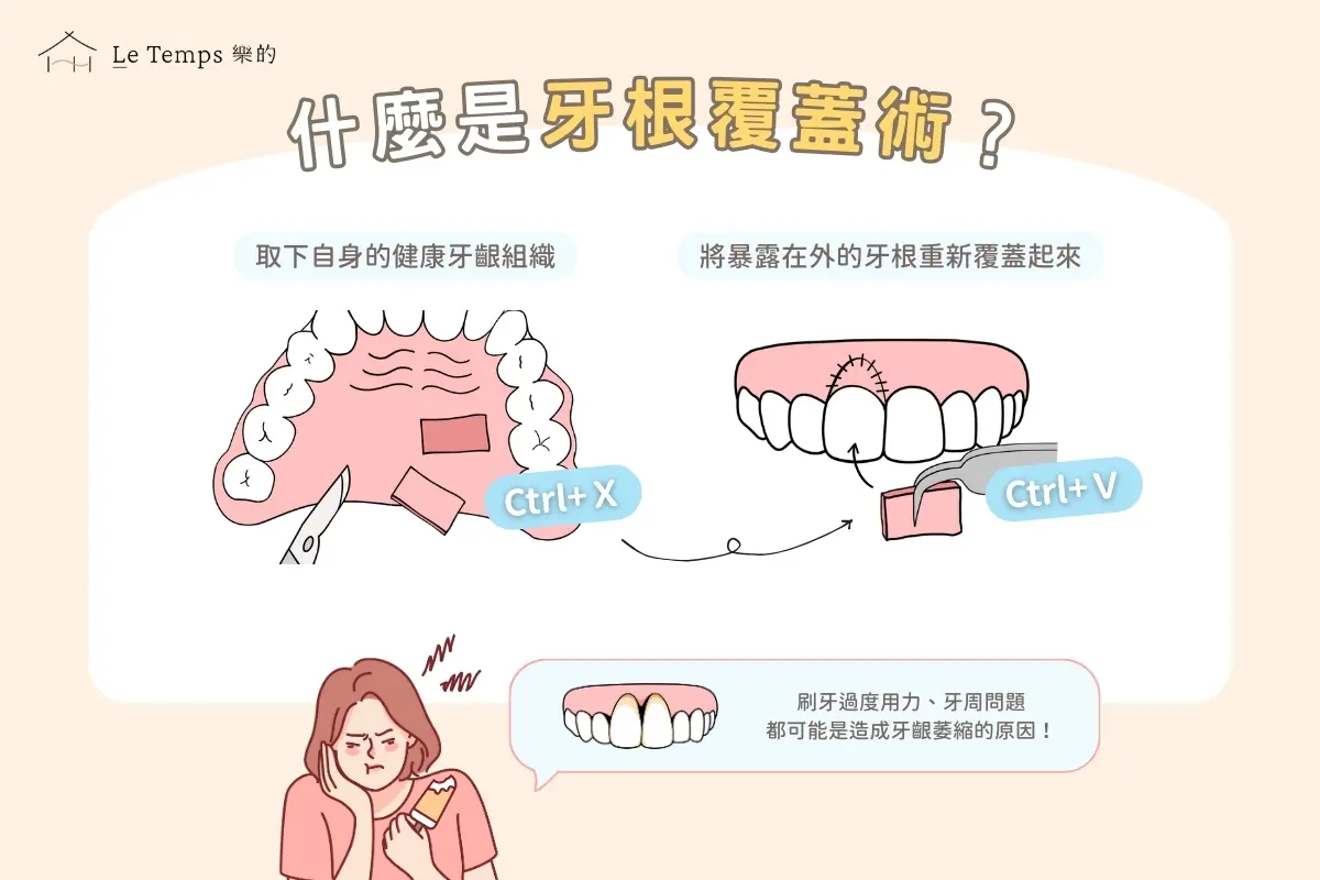 治療項目 牙根覆蓋術1