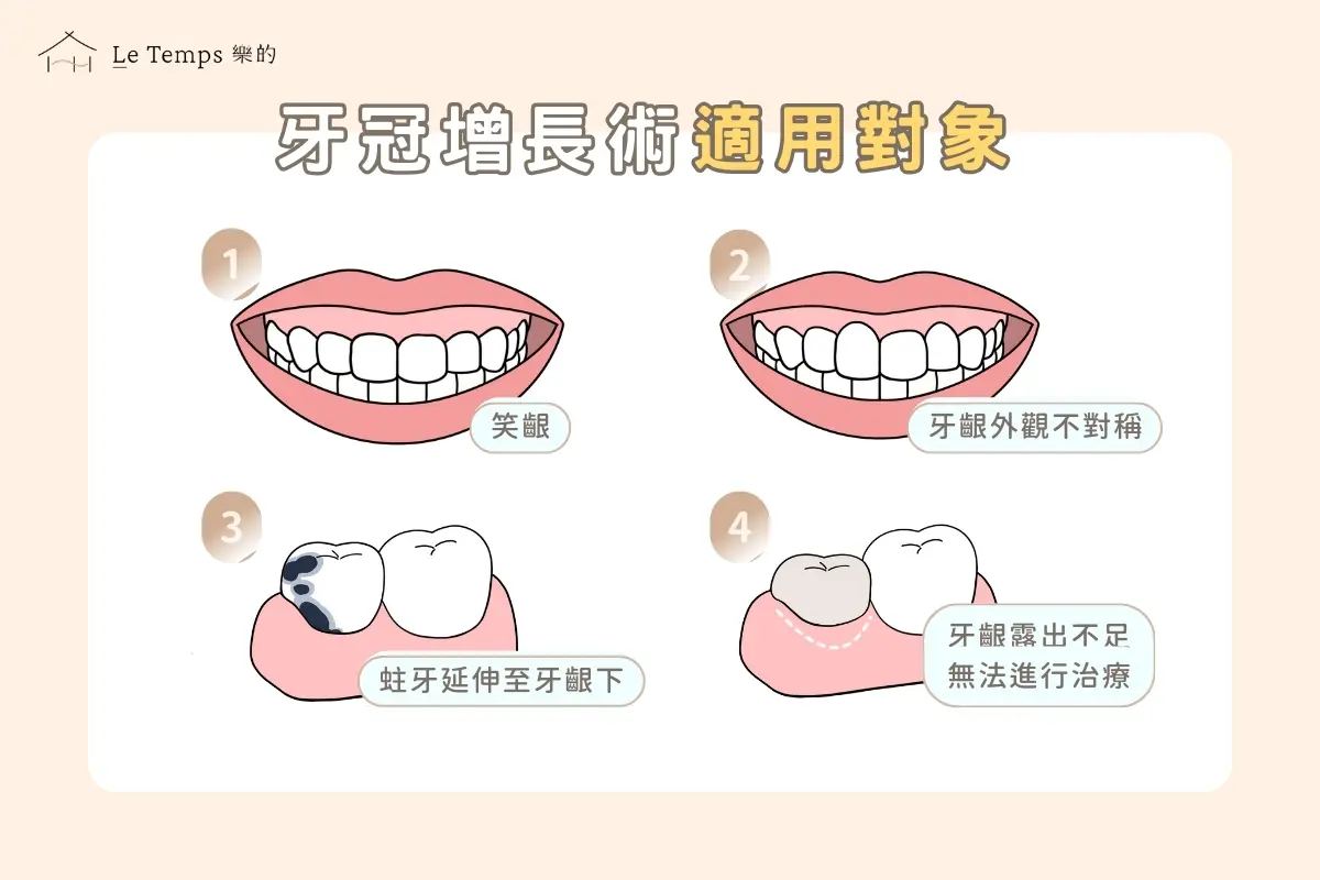治療項目 牙冠增長術4