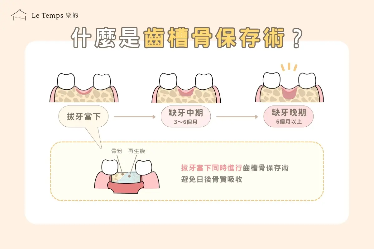 治療項目 齒槽骨保存術1