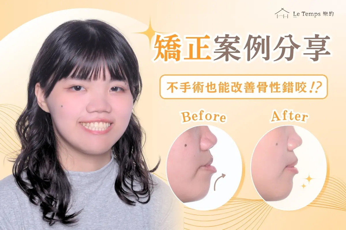 0126自鎖式矯正案例分享1