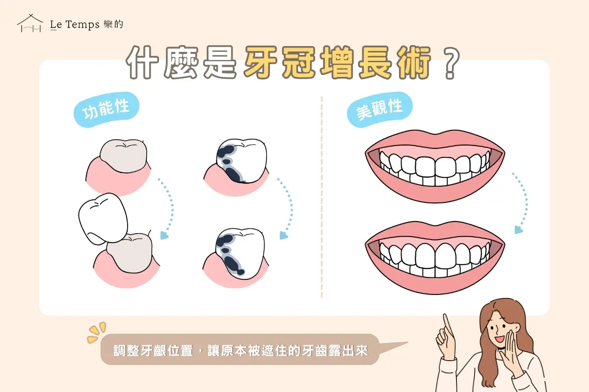 治療項目 牙冠增長術1