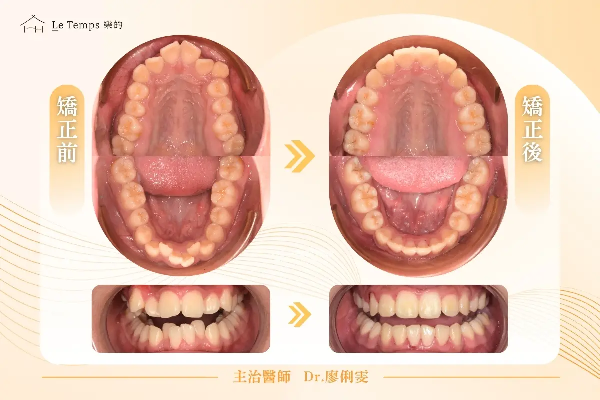 0225隱適美矯正案例分享2