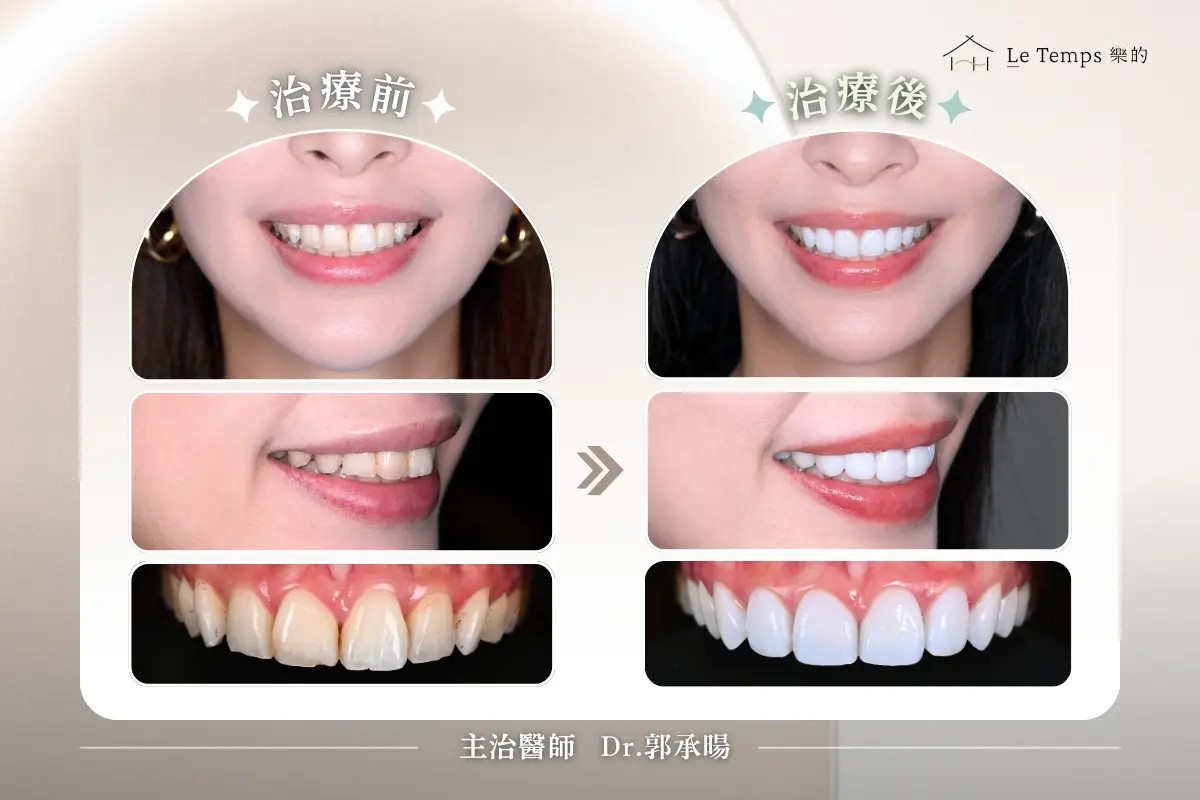 0211陶瓷貼片案例分享3