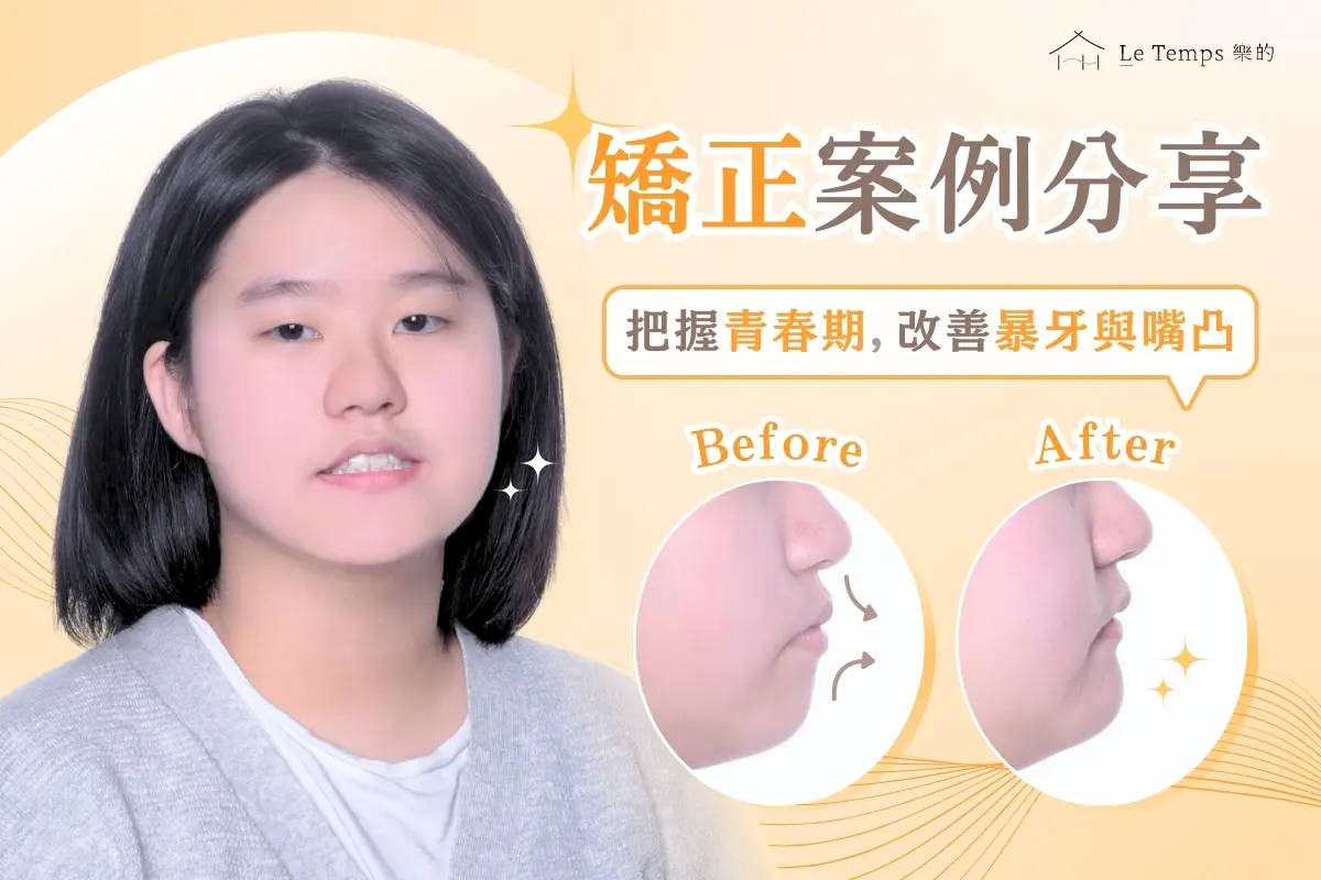 0225隱適美矯正案例分享1