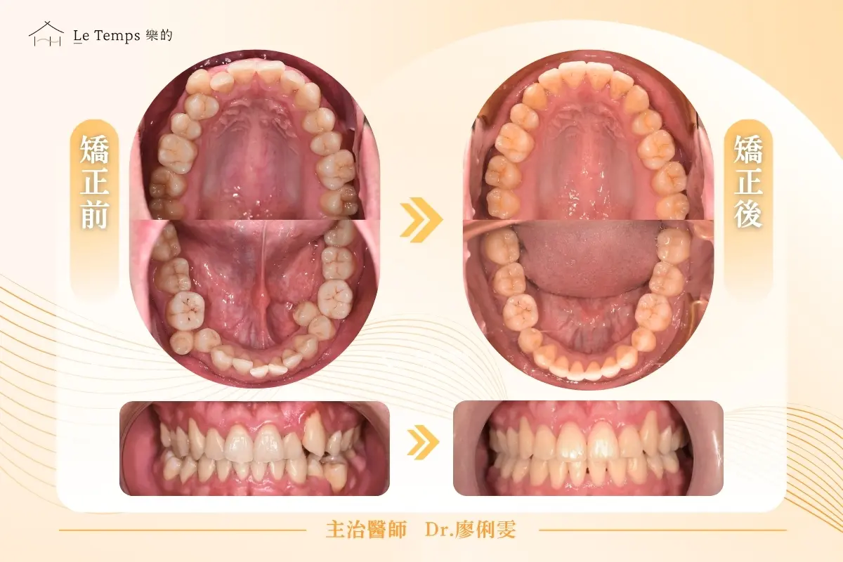 0416自鎖式矯正＋牙根覆蓋術案例分享2