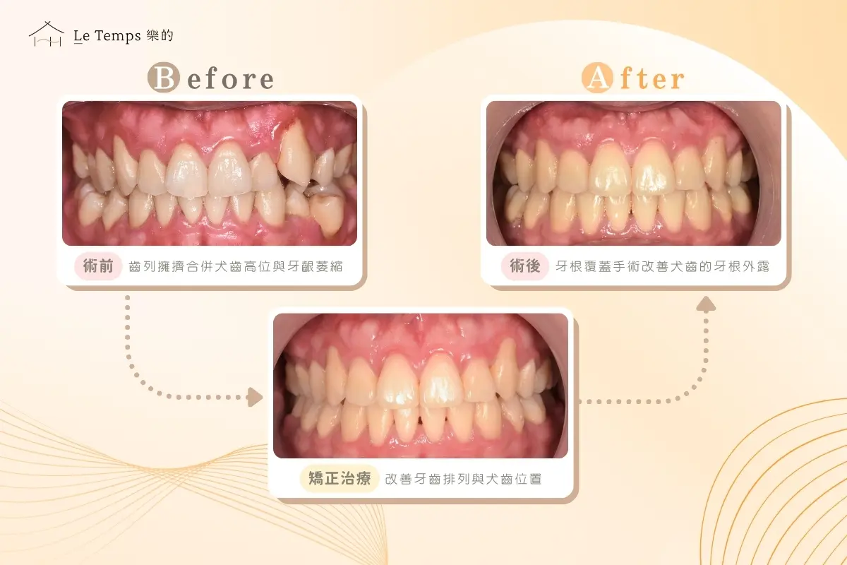 0416自鎖式矯正＋牙根覆蓋術案例分享3