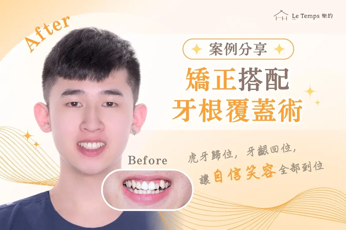 0416自鎖式矯正＋牙根覆蓋術案例分享1