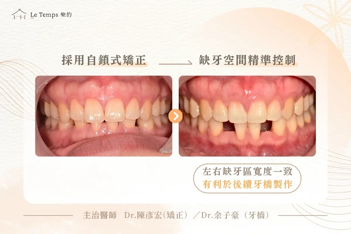 0427自鎖式矯正+馬利蘭牙橋案例分享2