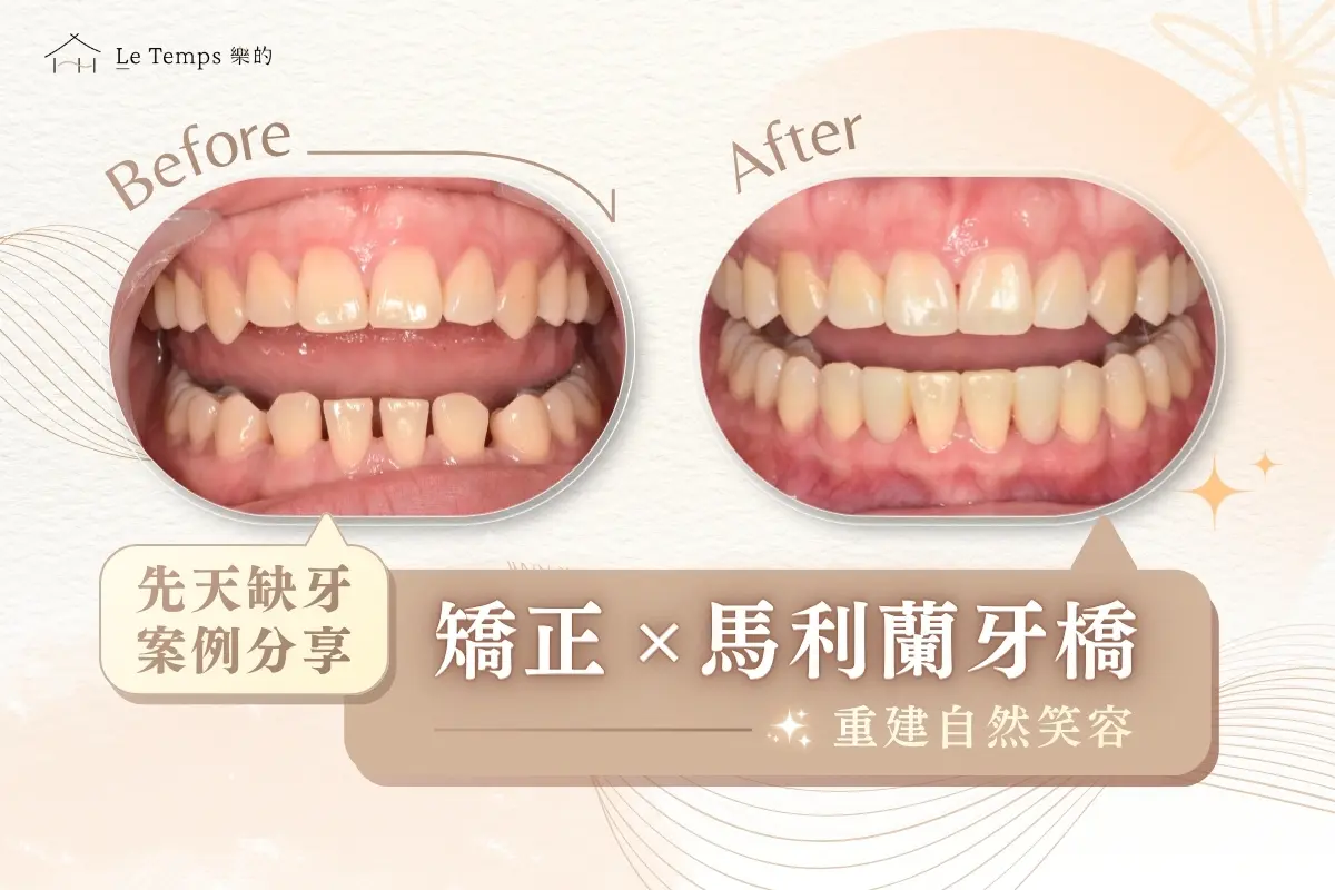 0427自鎖式矯正＋馬利蘭牙橋案例分享1
