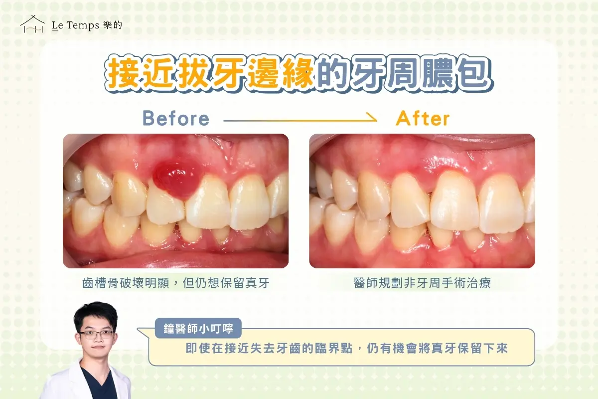 保留真牙大作戰｜牙周治療案例：不想開刀，也能把牙齒留住嗎？2