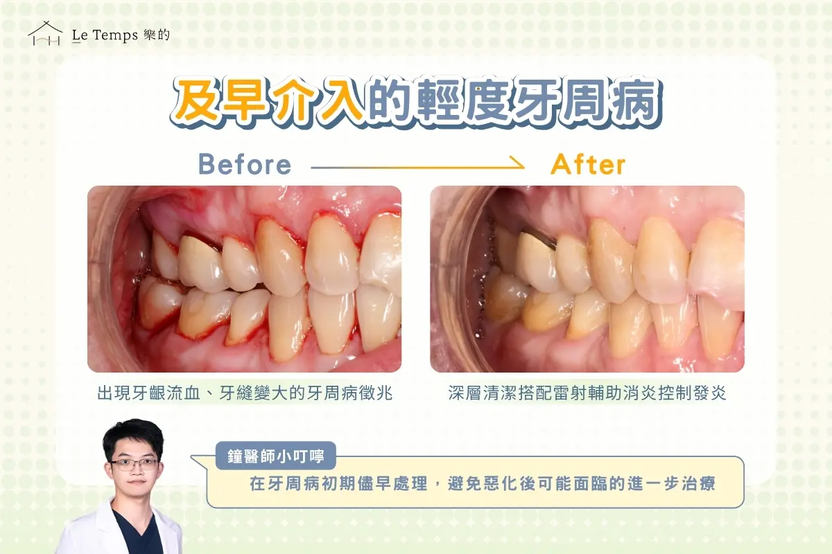 保留真牙大作戰｜牙周治療案例：不想開刀，也能把牙齒留住嗎？3