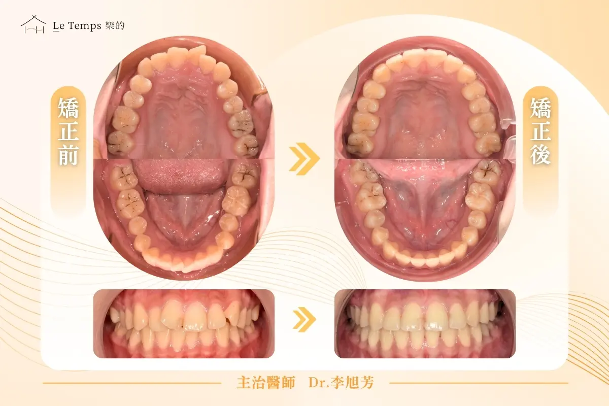 0511自鎖式矯正案例2