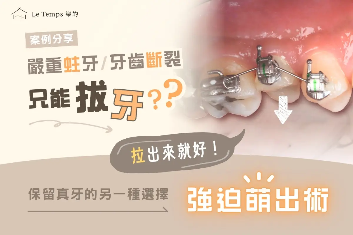 嚴重蛀牙、牙齒斷裂只能拔牙嗎？保留真牙的另一種選擇——強迫萌出術