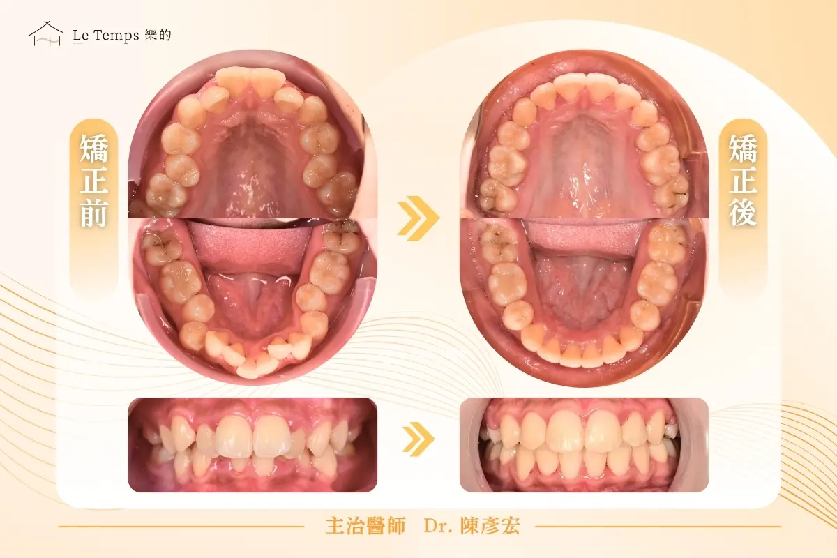 自鎖式矯正口內前後對比