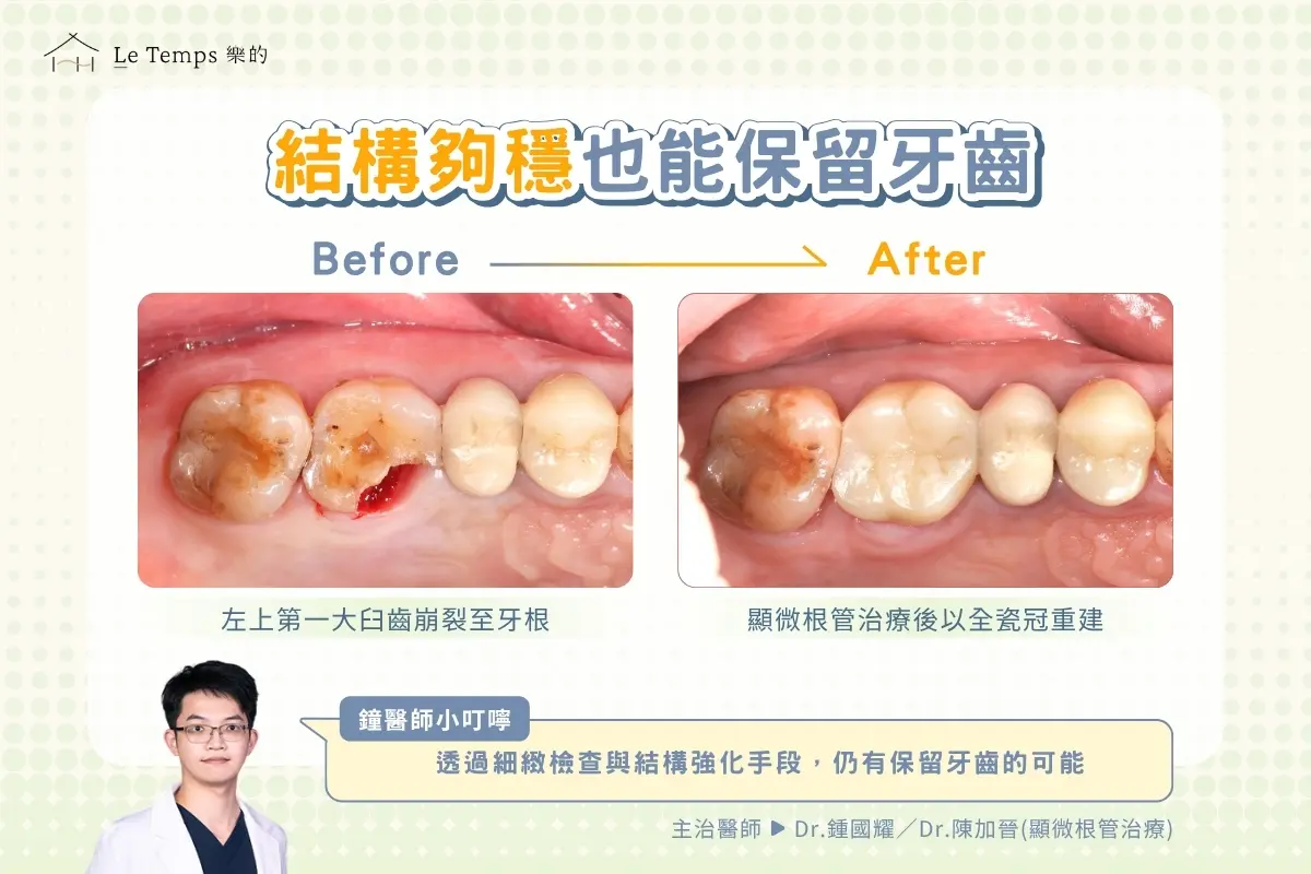 牙齒崩裂贋復案例