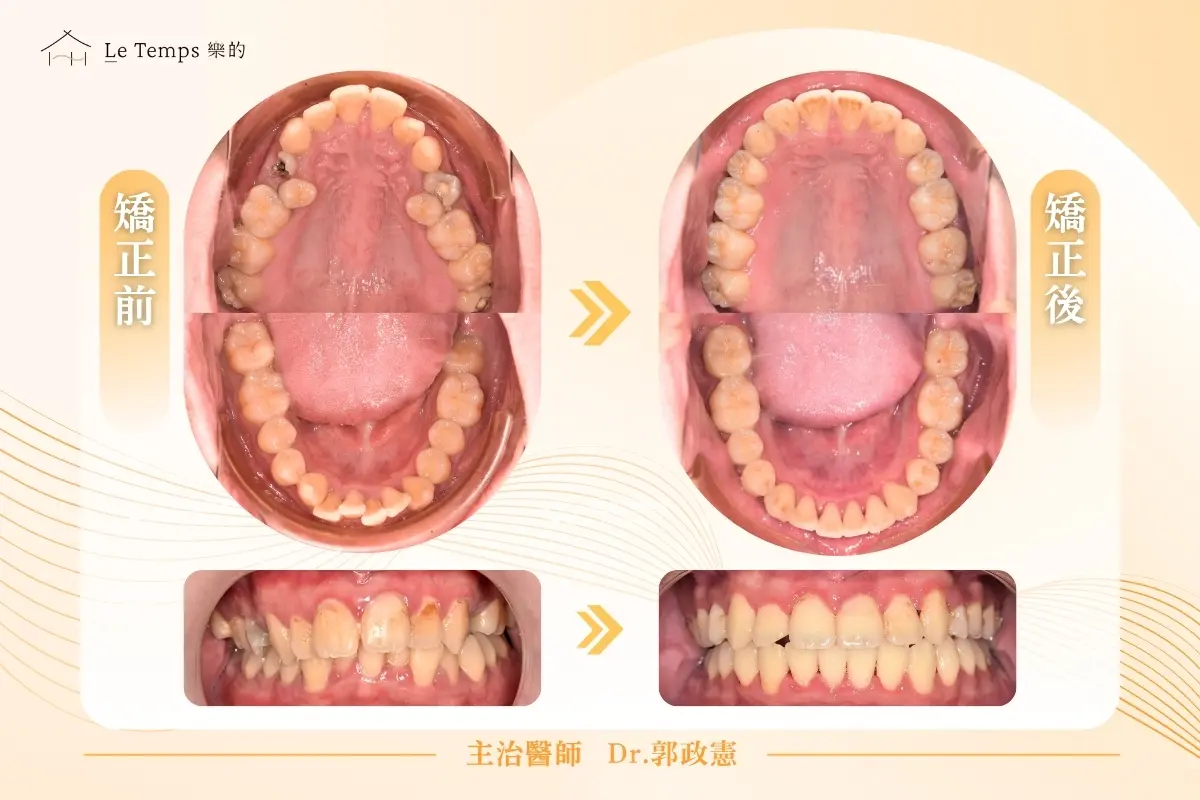 自鎖式矯正前後對比