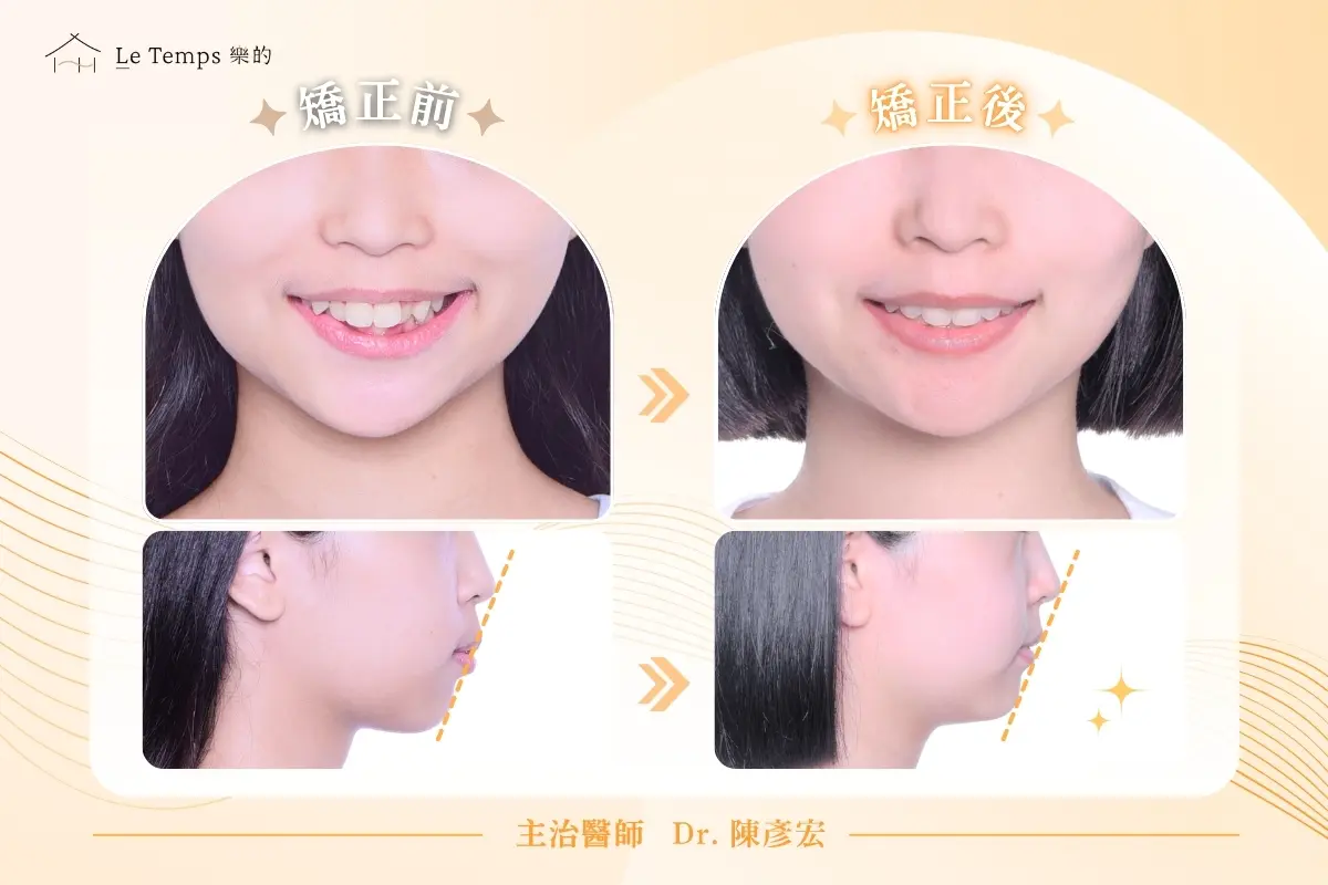 自鎖式矯正人像前後對比