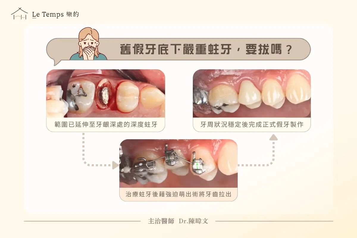 強迫萌出術案例 深度蛀牙