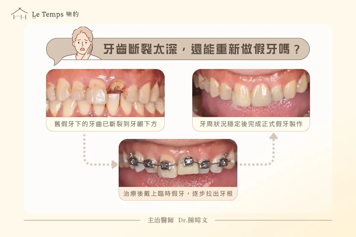強迫萌出術案例 牙齒斷裂