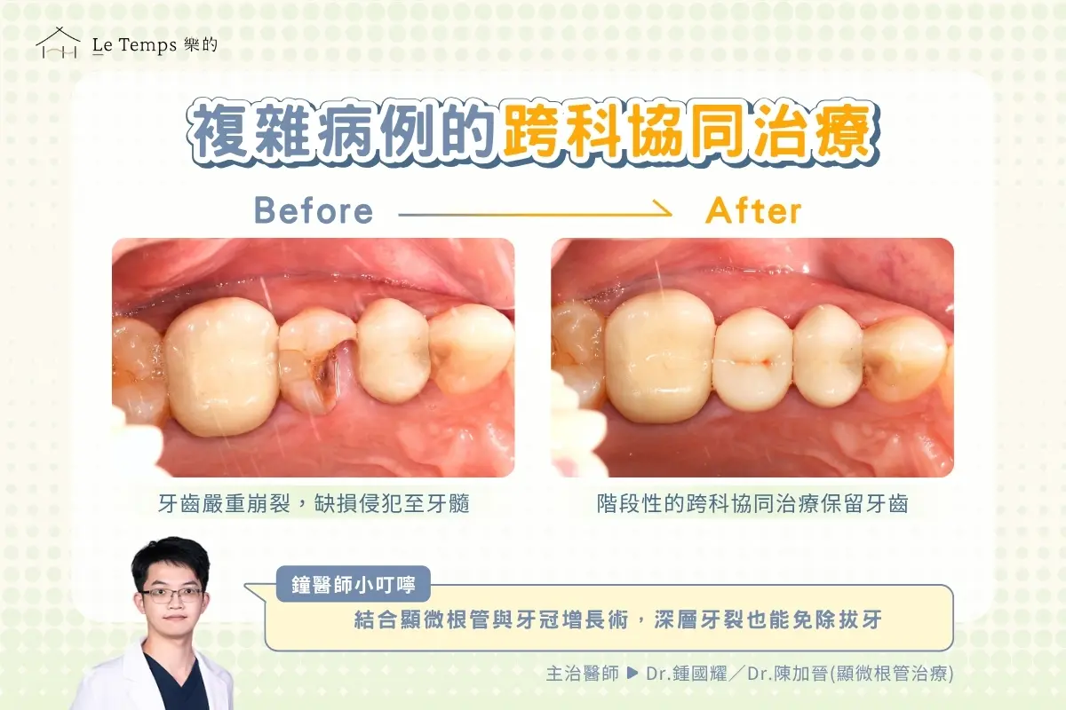牙齒崩裂跨科治療案例