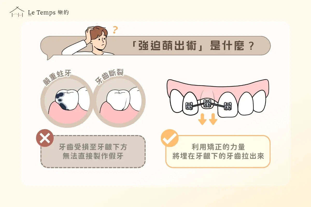 強迫萌出術介紹 1