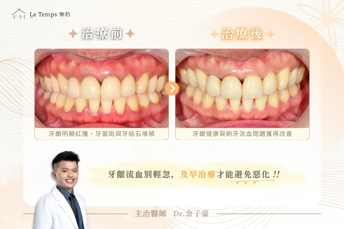 水雷射牙周病治療案例前後對比