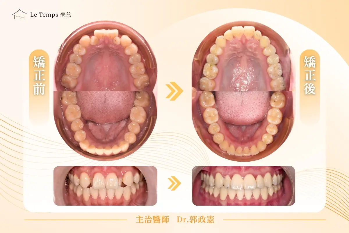 自鎖式矯正口內前後對比 2