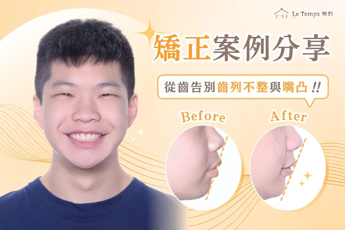 自鎖式矯正 齒列不整與嘴凸 1