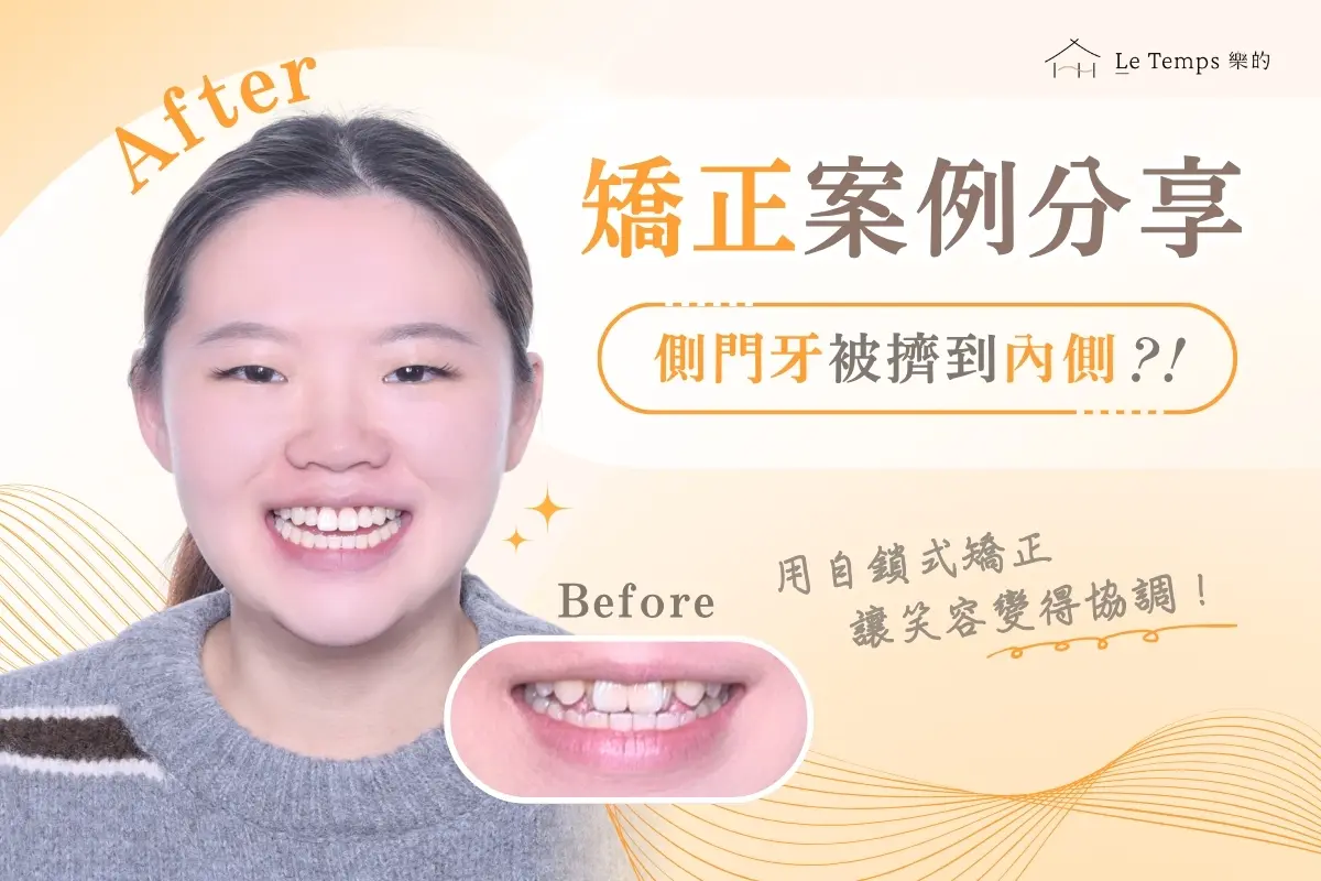 自鎖式矯正 齒列不整