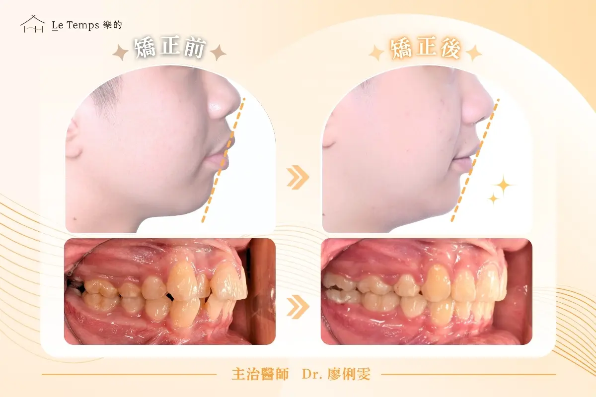 自鎖式矯正人像前後對比 1
