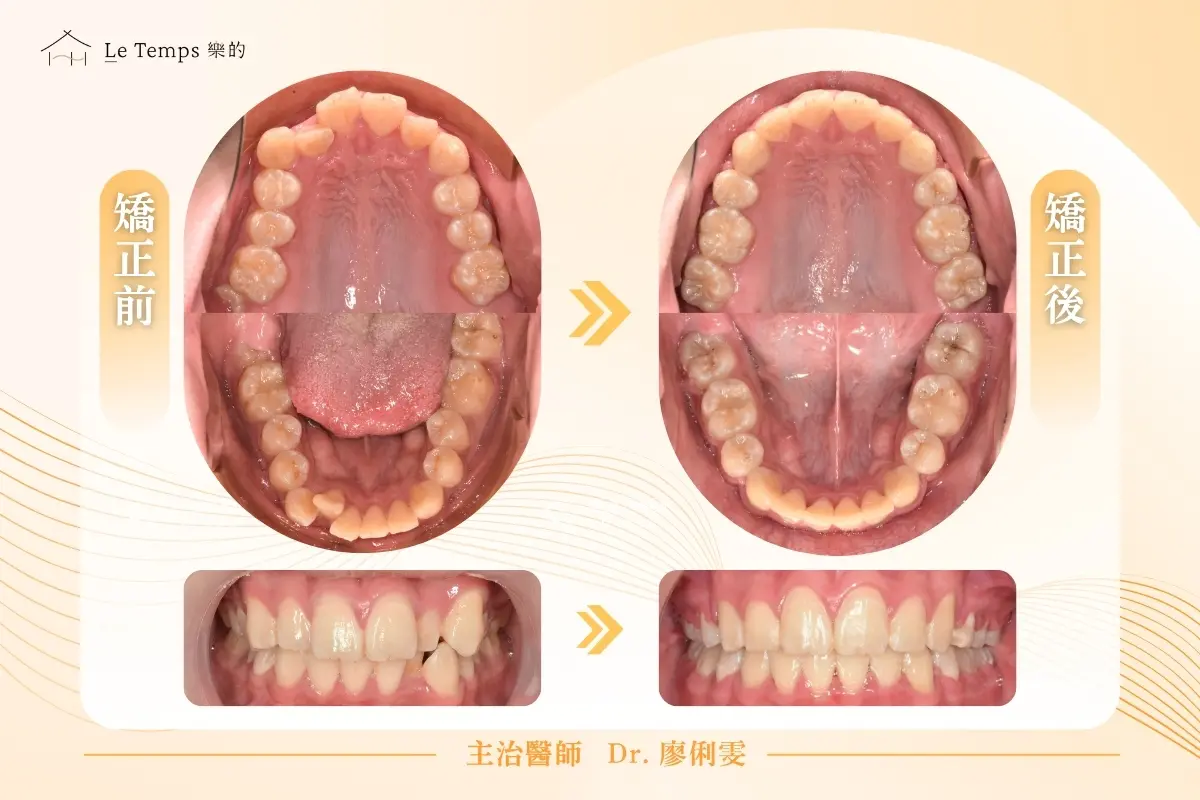 自鎖式矯正口內前後對比 1