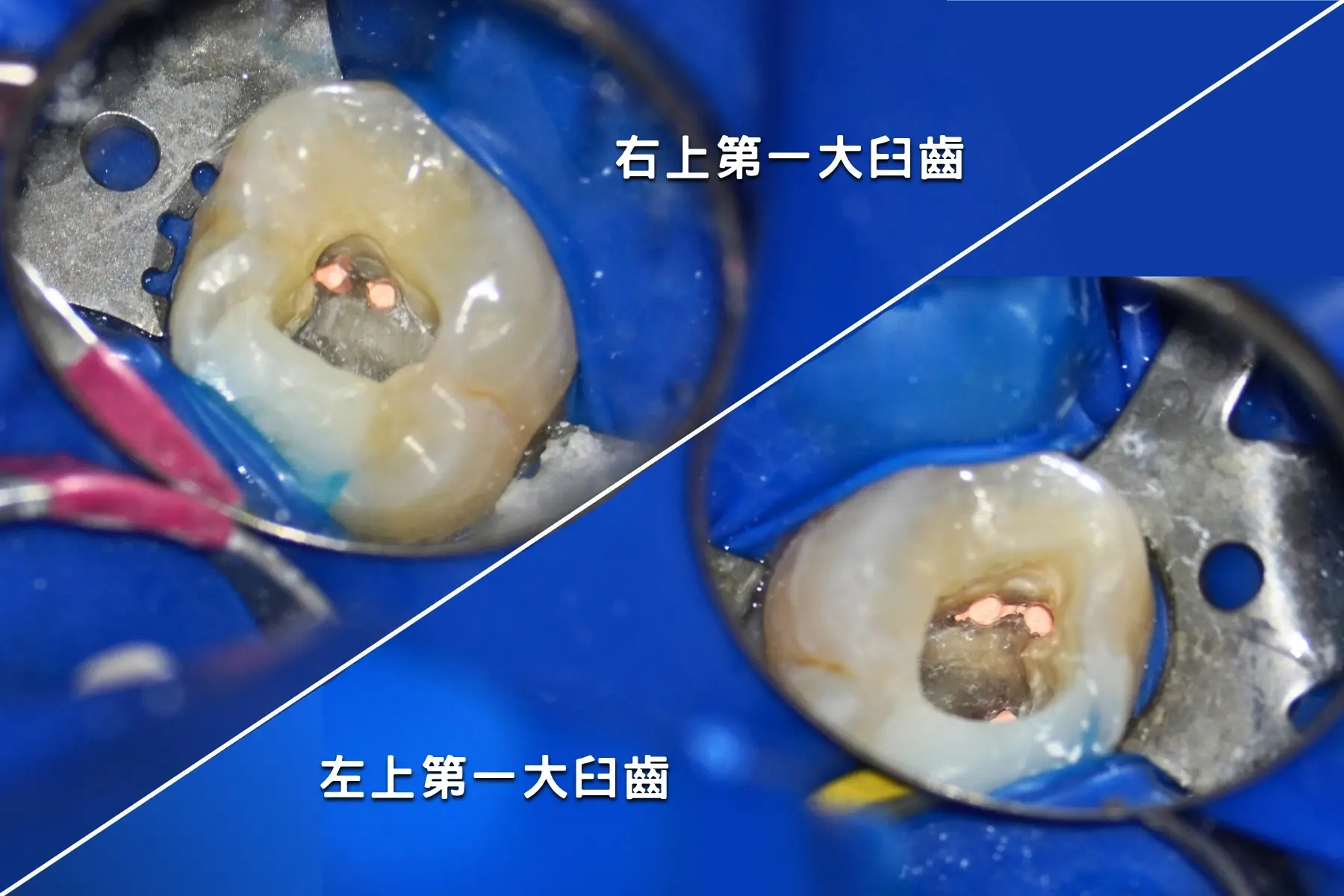 術後 58