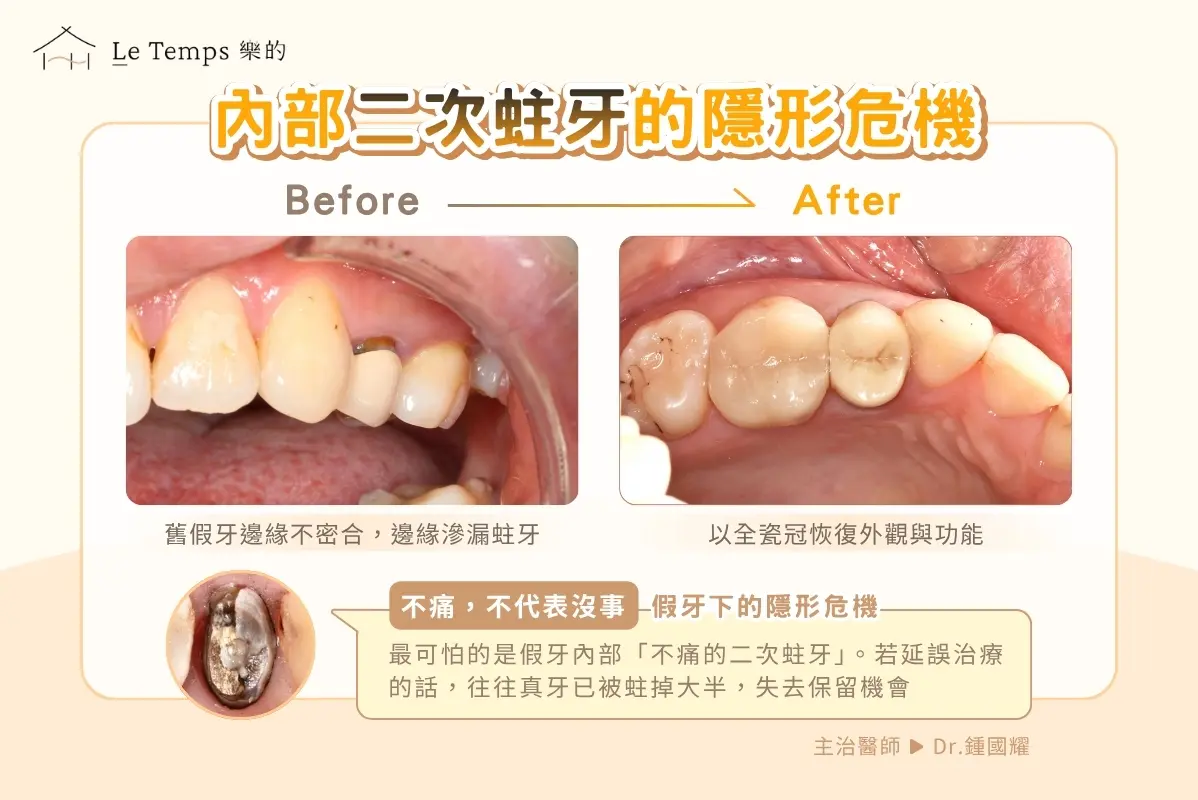 二次蛀牙 全瓷冠案例