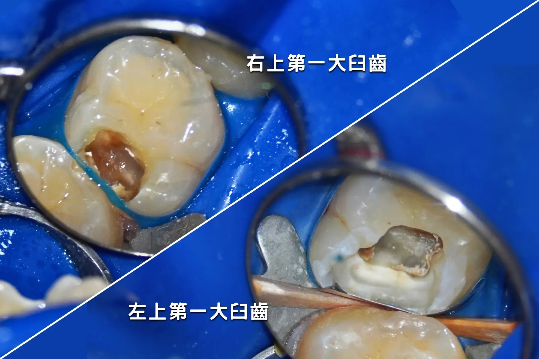 術前 61