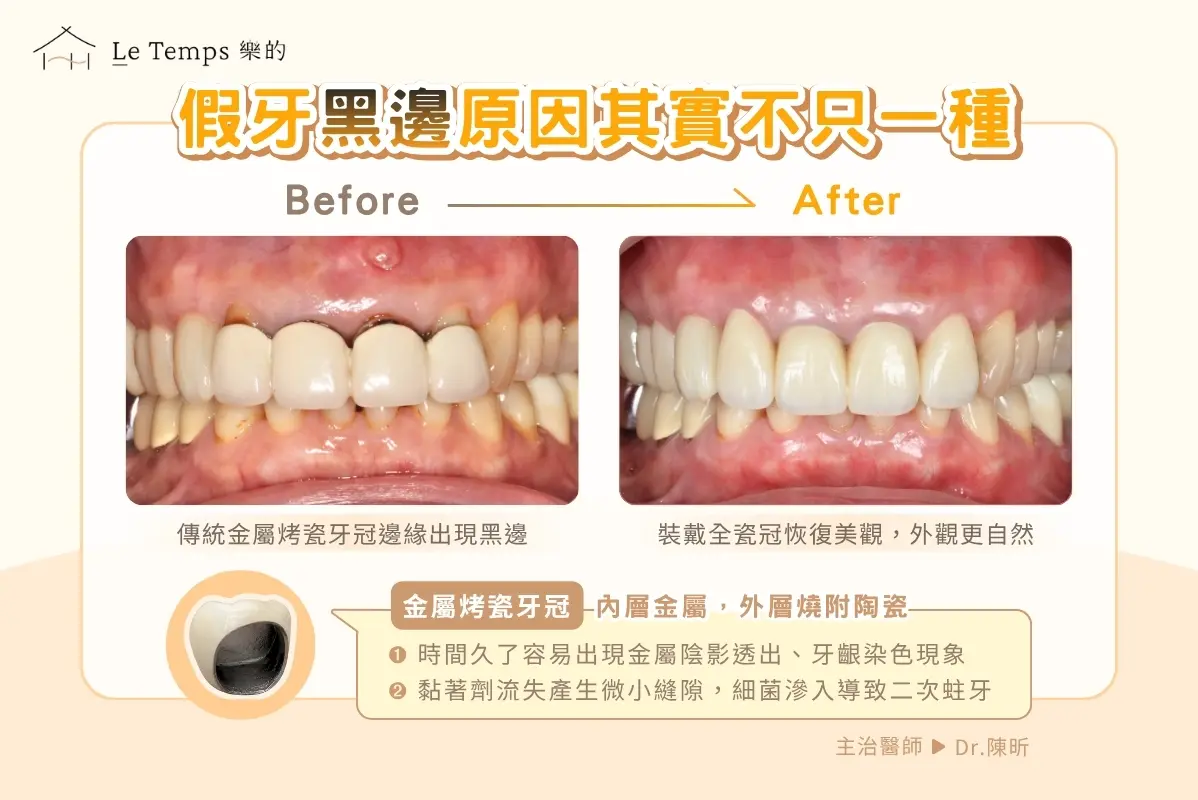 假牙黑邊 全瓷冠案例