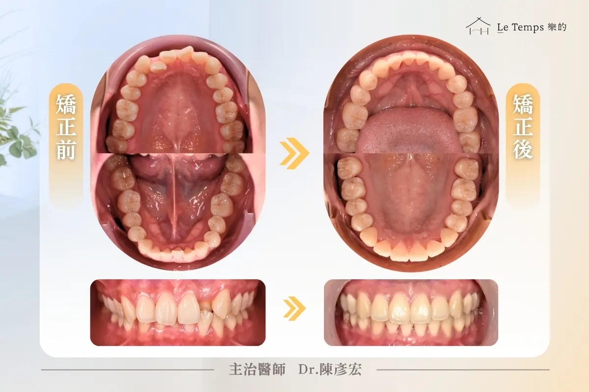 自鎖式矯正口內前後對比 3