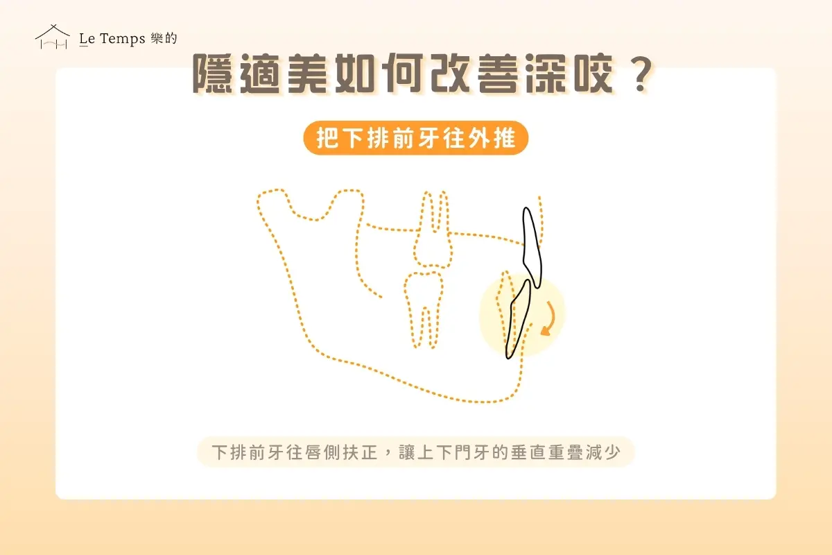 隱適美如何改善深咬?