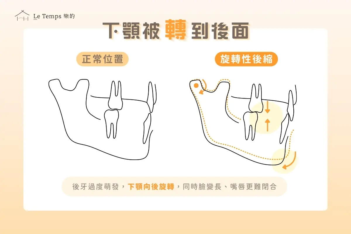 旋轉性後縮