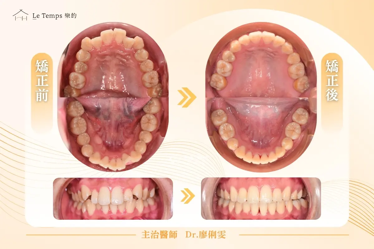 自鎖式矯正口內前後對比 4