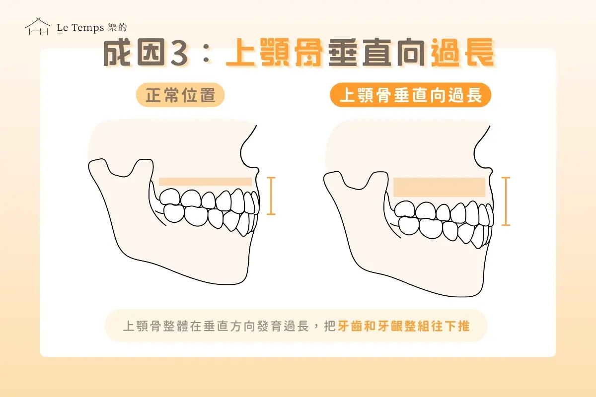 上顎骨垂直向過長