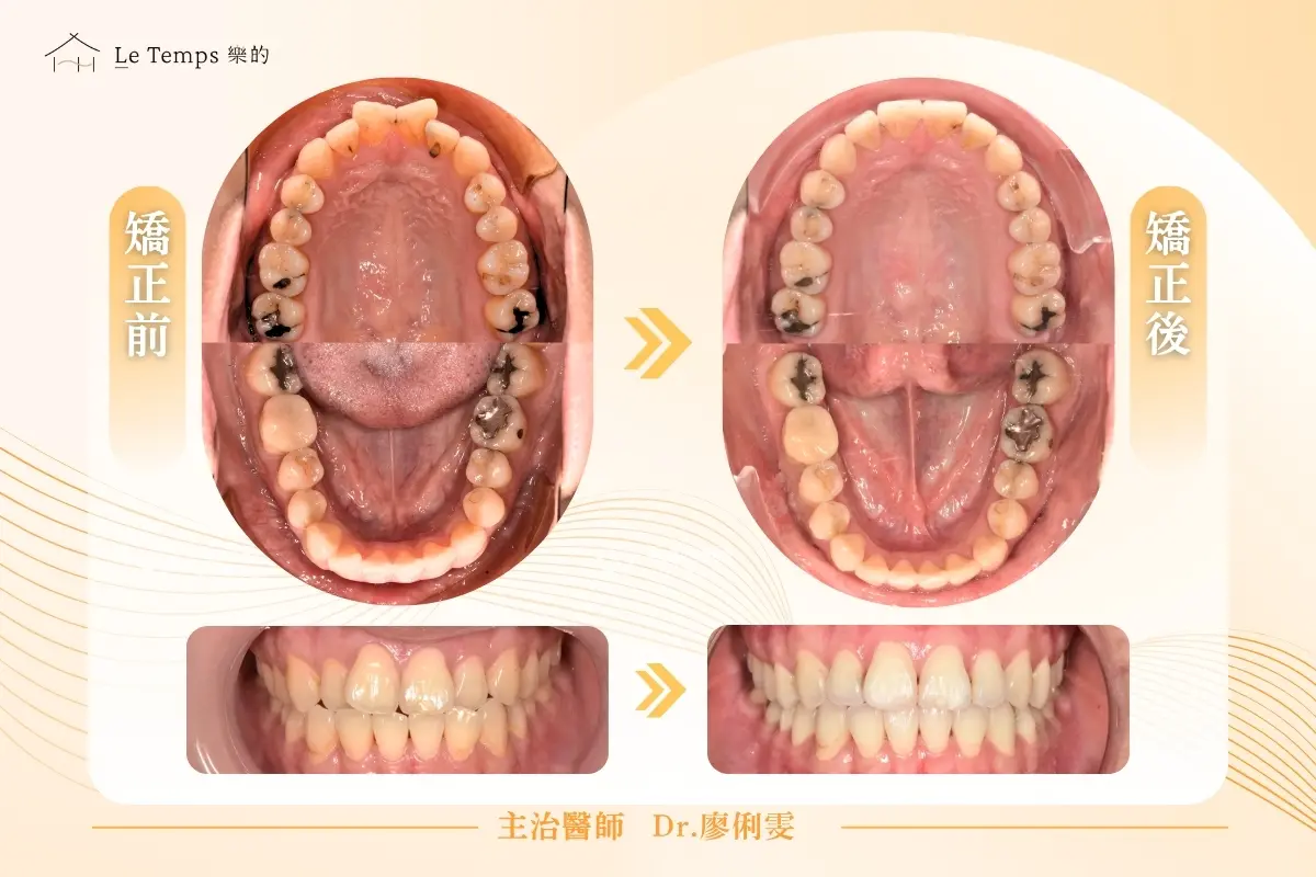 隱適美矯正口內前後對比