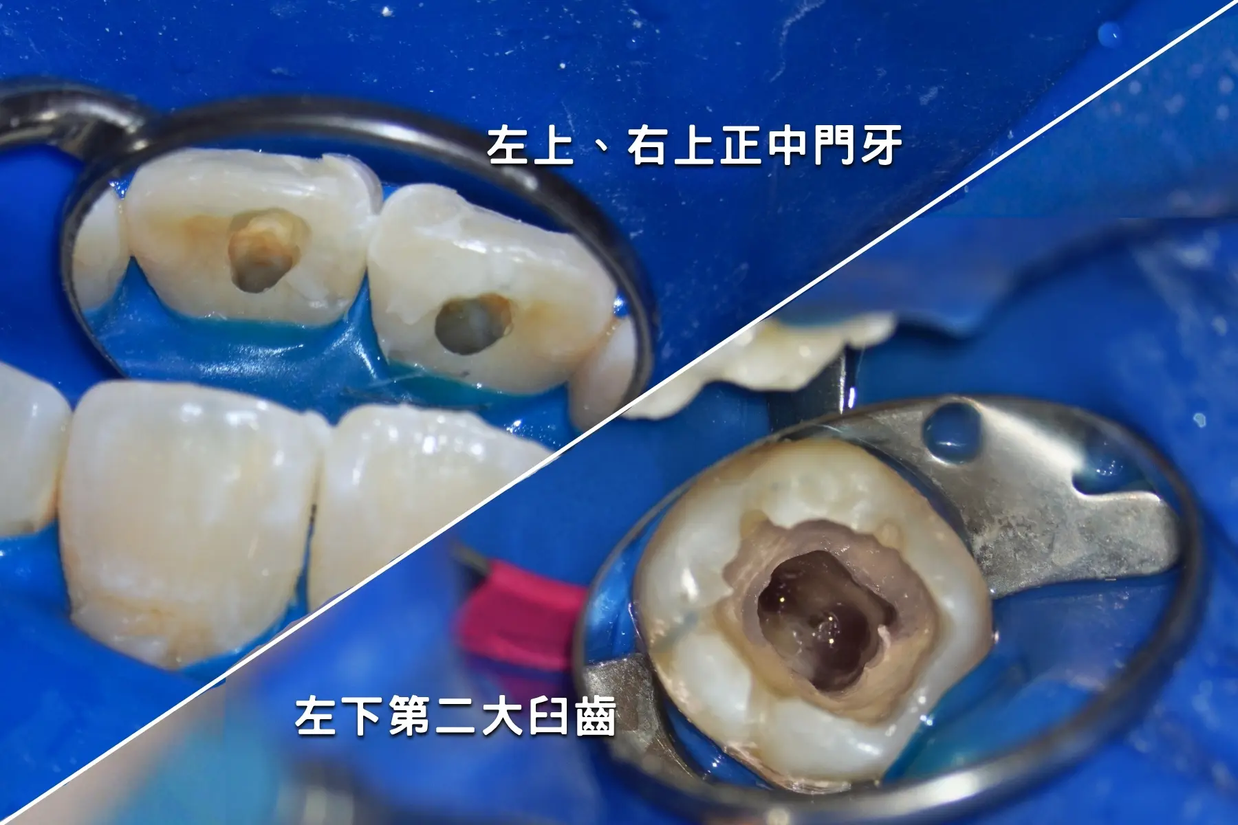 術前 62