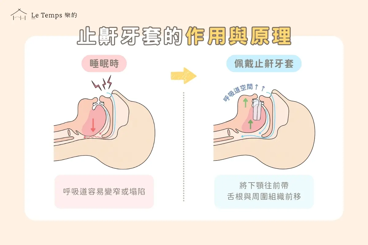 止鼾牙套的作用與原理