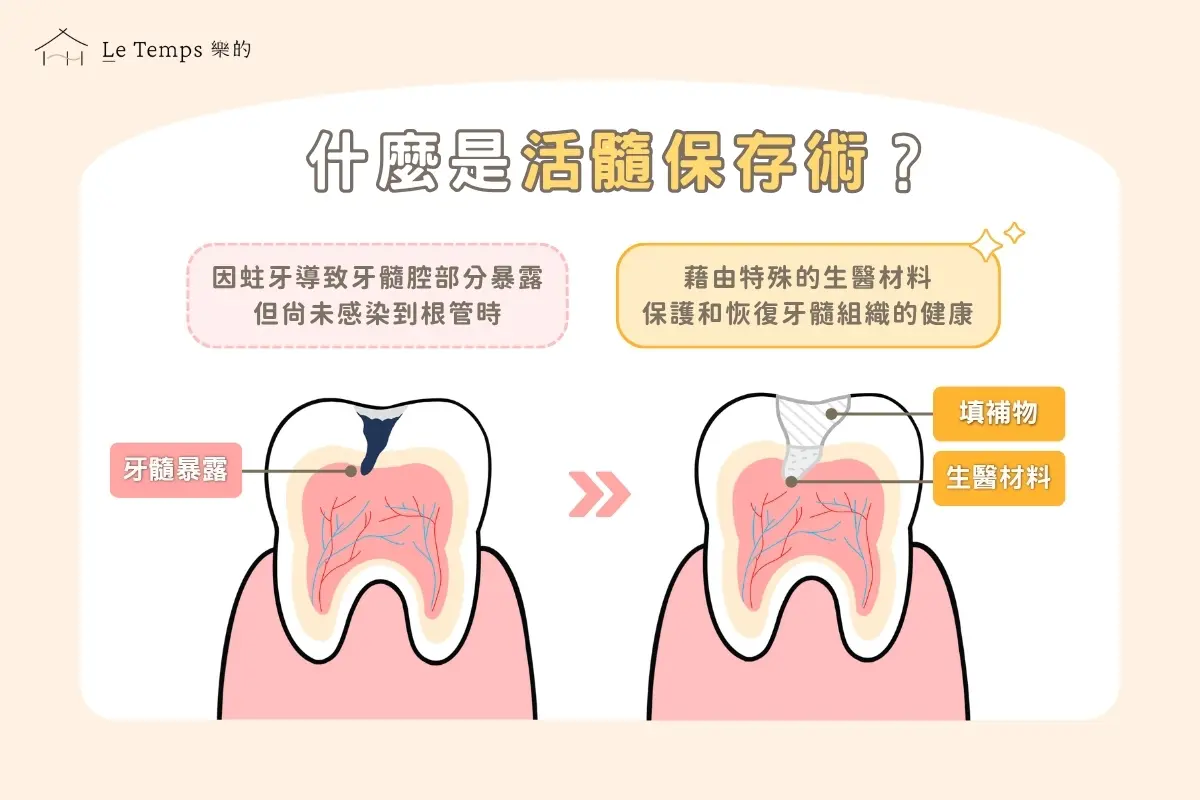 什麼是活髓保存術